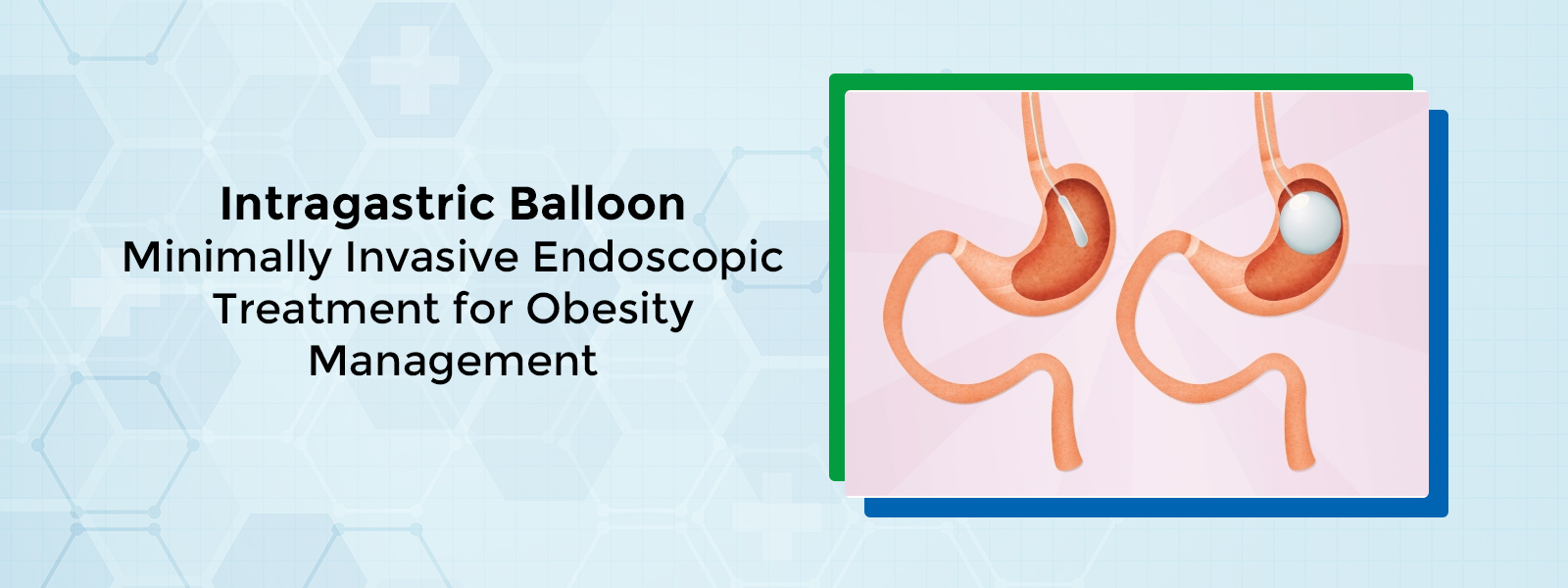 Intragastric Balloon: Minimally Invasive Endoscopic Treatment for Obesity Management