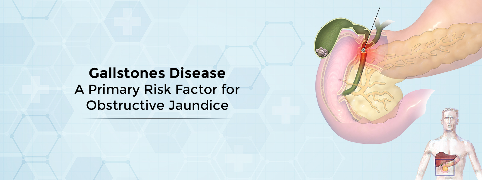 Gallstones Disease: A Primary Risk Factor for Obstructive Jaundice